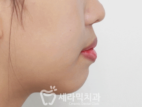 돌출입 치아교정전후. 갸름하고 세련된 입술을 되찾다! 관련 이미지 1
