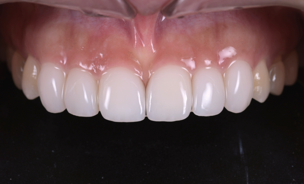 앞니 벌어짐, 교정 없이 라미네이트로 해결한 경우 관련 이미지 5