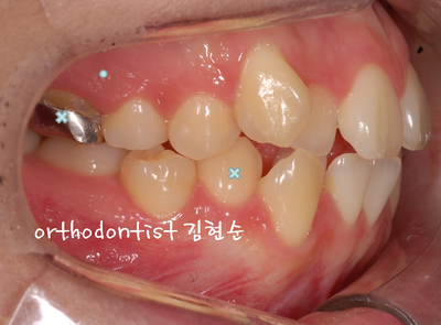 치열 교정(치열 불규칙) 관련 이미지 18