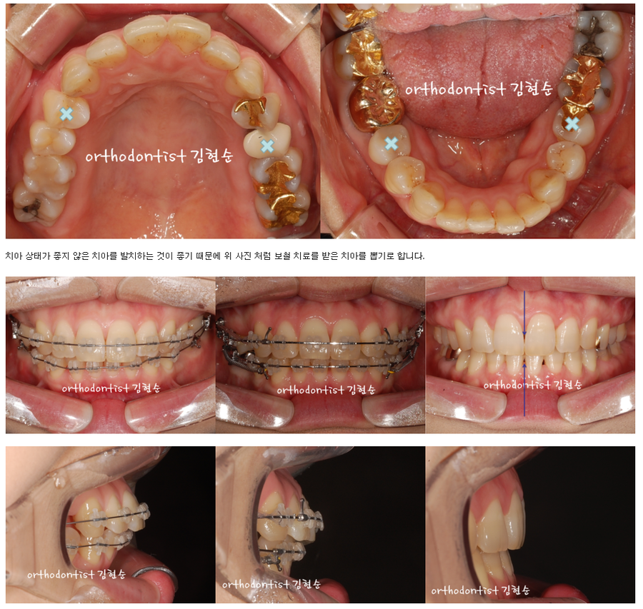 세라믹교정 세라믹치과-돌출입발치교정 10 관련 이미지 4