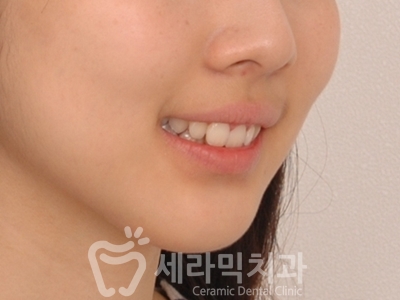 과개교합 치아교정잘하는곳, 세라믹치과 치아교정전후! 관련 이미지 11