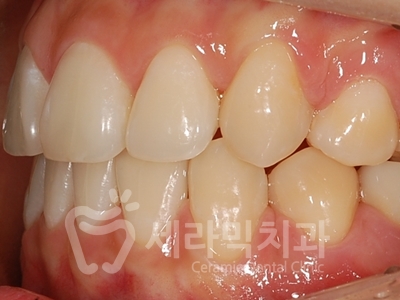 돌출입 덧니 비대칭 치아교정 전후 인상변화! 관련 이미지 19
