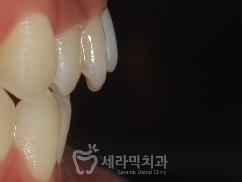 Open Bite Dental Clinic Orthodontic Before and After: Did a Long-Looking Jaw Become Shorter? image 5