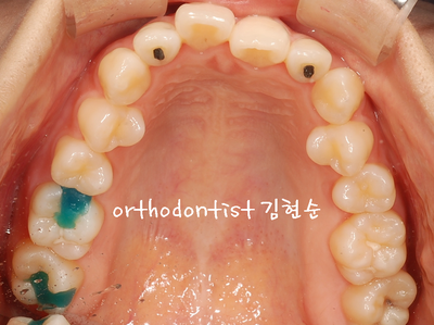 개방 교합 관련 이미지 7