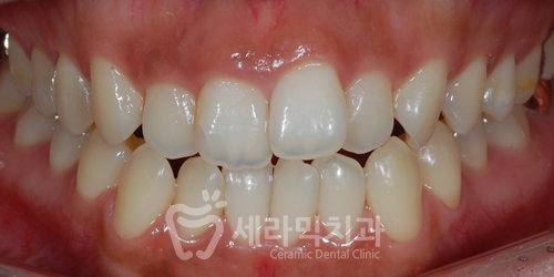 Open Bite Dental Clinic Orthodontic Before and After: Did a Long-Looking Jaw Become Shorter? image 3