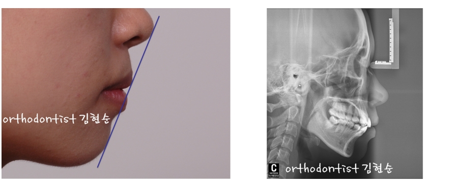 세라믹교정 은 세라믹치과 수술없이 돌출개선 관련 이미지 4