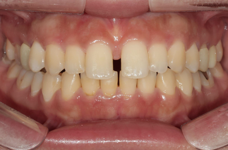 앞니 벌어짐, 교정 없이 라미네이트로 해결한 경우 관련 이미지 3