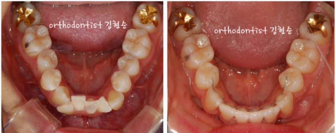 강남 덧니 관련 이미지 16