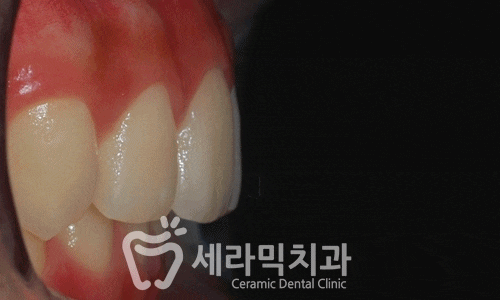 과개교합, 딥바이트 비발치 치아교정전후 관련 이미지 7