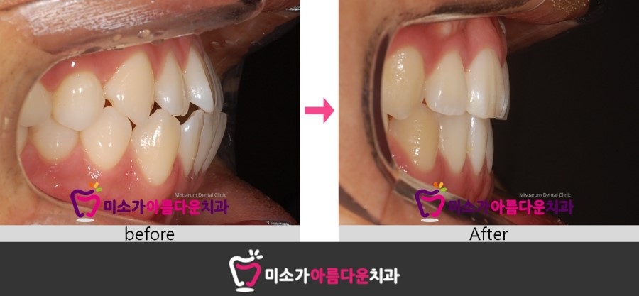 세라믹치과 돌출입교정 관련 이미지 3