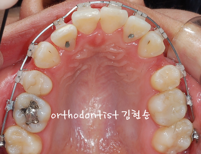 강남 돌출 관련 이미지 17