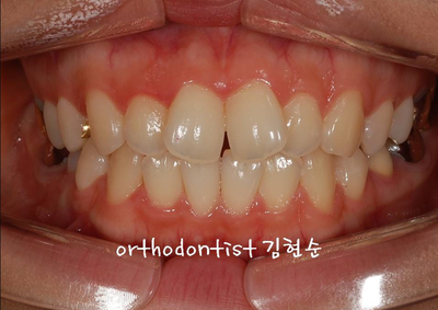 강남 돌출입 교정 관련 이미지 6