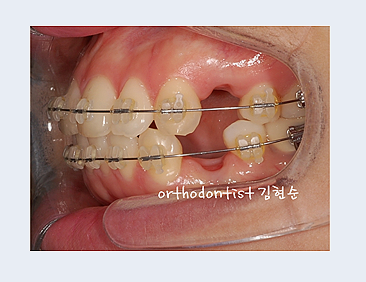 강남교정치과 관련 이미지 23