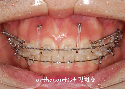 강남 돌출 관련 이미지 28