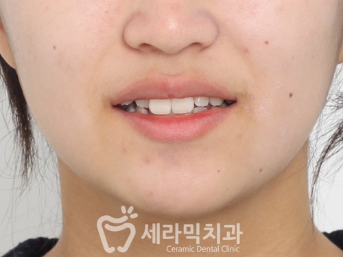 교정 전 어색한 웃음이 치아교정전후 함박웃음으로 변하게 된 사례 관련 이미지 1