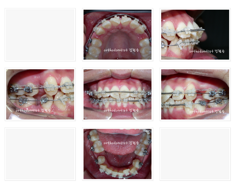 앞니가 돌출된 경우, 발치 교정 후 블랙 트라이앵글(치아 사이 공간) 삭제 관련 이미지 3