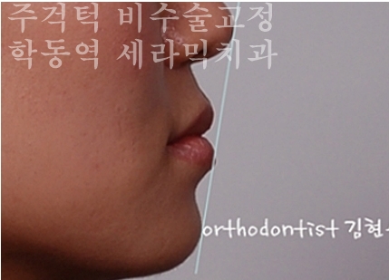 주걱턱 비수술 치아교정 잘하는 학동역 세라믹치과 관련 이미지 7