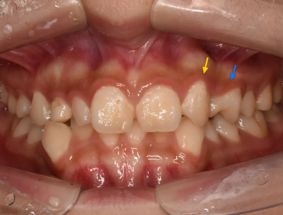 왜소치, 결손치가 동시에 있었던 환자의 앞니 심미보철 관련 이미지 6