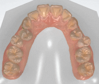 3D 스캐너를 이용한 교정 심뮬레이션 관련 이미지 10
