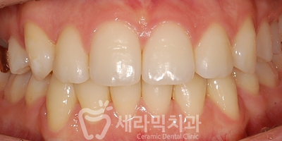 덧니 세라믹교정 전후사진, 학동역 세라믹치과 관련 이미지 6