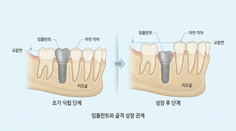 Treatment for Missing Teeth: Is Orthodontics or an Implant Better? image 4