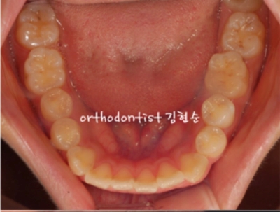 강남치아교정추천 관련 이미지 10