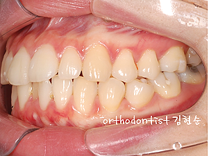 강남 돌출입 교정 관련 이미지 7