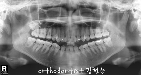 개방 교합 관련 이미지 13