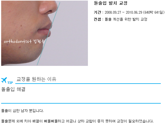 세라믹교정 세라믹치과-돌출입발치교정 1 관련 이미지 1