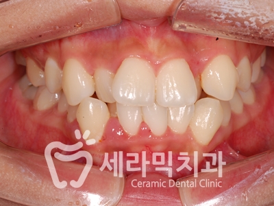 토끼이빨, 틀어진 치아배열 세라믹교정 전후사진 관련 이미지 4