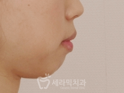 20대 돌출입교정, 무턱교정, 치아교정전후 세련된 얼굴 라인을 되찾다! 관련 이미지 10