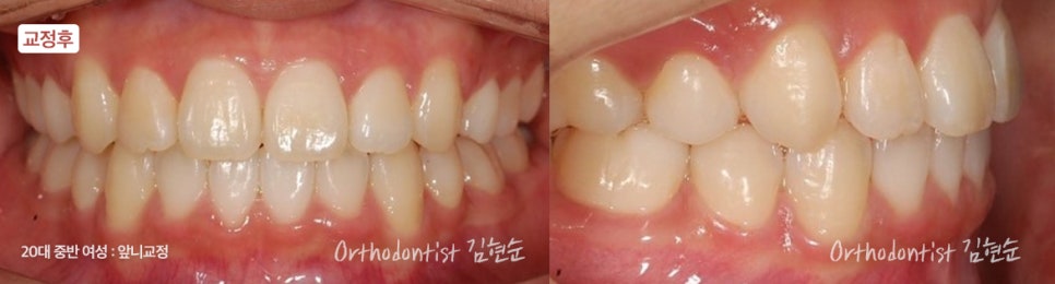 강남치아교정 브라켓비교분석 관련 이미지 21