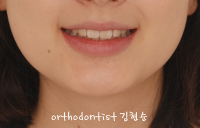 강남 돌출 (토끼 치아) 관련 이미지 31