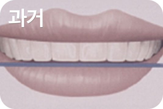 미소모양 치아교정과 스마일아크 관련 이미지 2