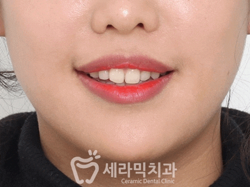 딥바이트 과개교합 치아교정전후 변화 관련 이미지 3