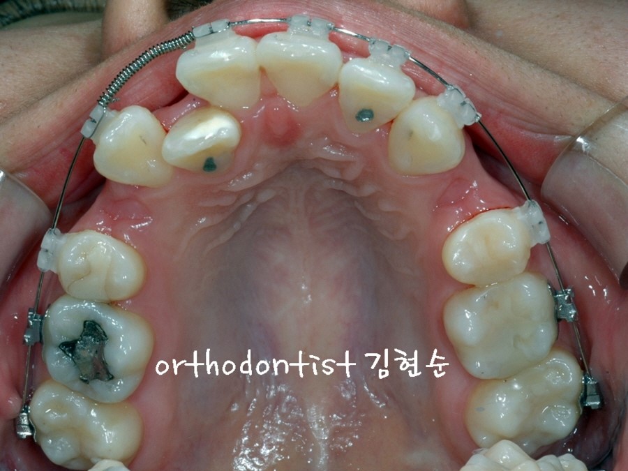 학동역치과 돌출입교정 세라믹치과에서 ~ 관련 이미지 4