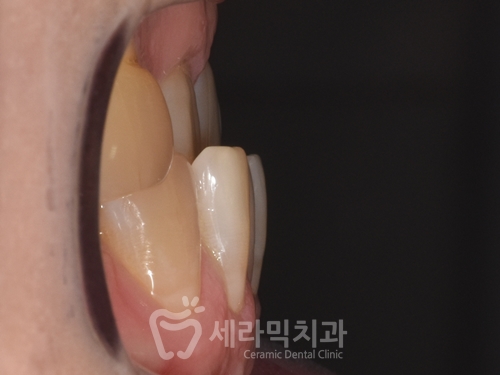 40대에 이어 50대 치아교정 전후사례 증가 추세 관련 이미지 10