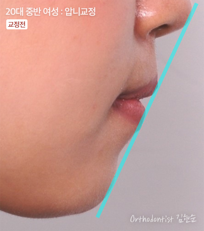 강남치아교정 브라켓비교분석 관련 이미지 15