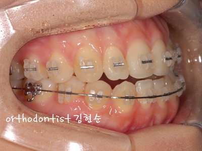 개방 교합 관련 이미지 24