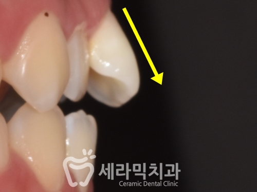 혀내밀기 습관과 개방교합, 오픈바이트(Open bite) 치아교정전후 보기 관련 이미지 5