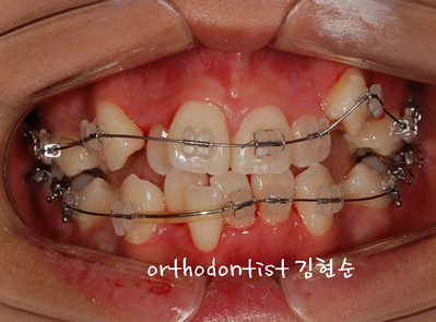 강남 덧니 관련 이미지 14