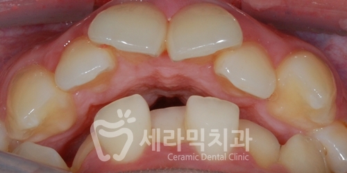 치아교정만으로 세마리 토끼를 한번에! 돌출입, 무턱, 치열불규칙 치아교정전후 관련 이미지 4