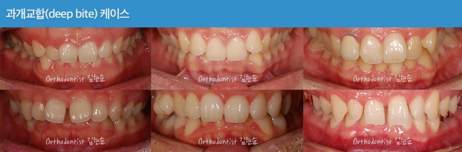 과개교합 무턱 개선 관련 이미지 4