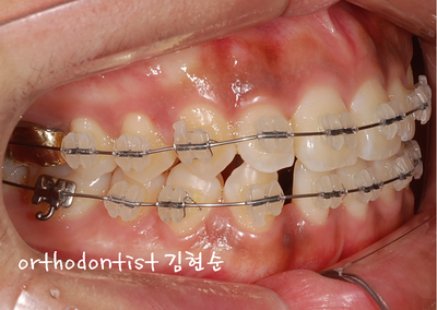 치열 교정 ( 벌어짐 ) 관련 이미지 16