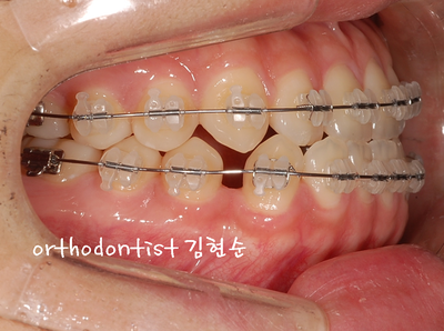 반대 교합 관련 이미지 16