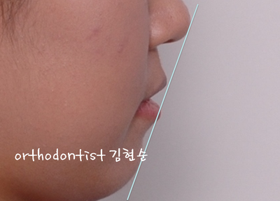 치열 교정(치열 불규칙) 관련 이미지 12