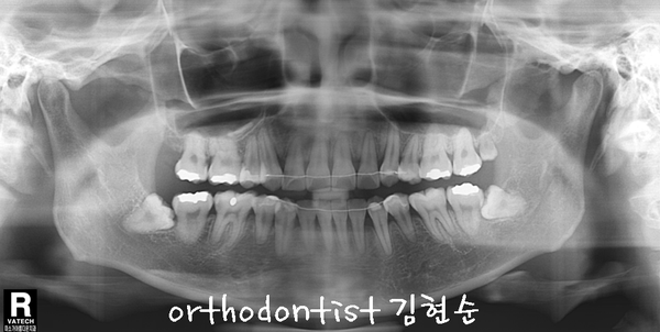 강남 덧니 관련 이미지 29