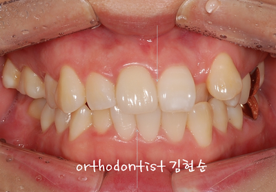 강남 덧니, 돌출 관련 이미지 4