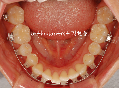 돌출 교정 (비발치 교정/비대칭) 관련 이미지 18