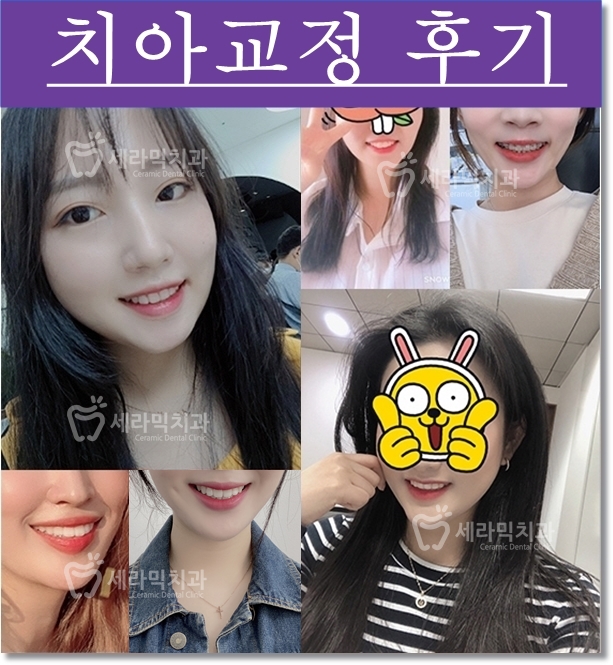 딥바이트 과개교합 치아교정전후 활짝 웃게 된 사례 관련 이미지 5